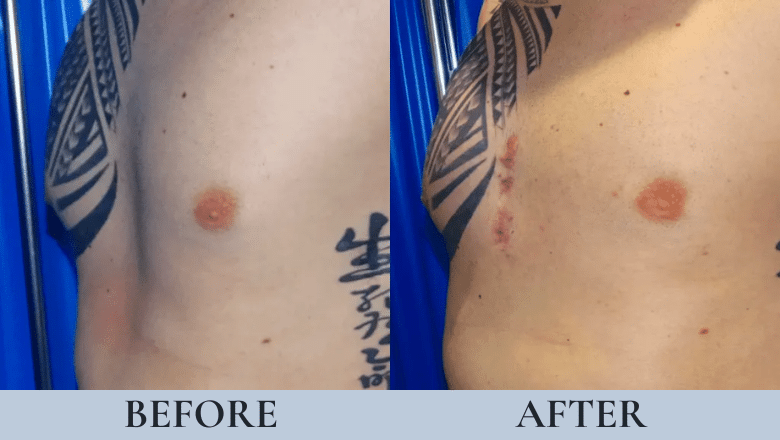 male pectoral implants before after photos 2