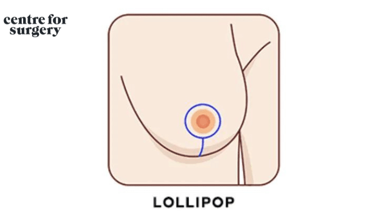 lollipop incision breast lift