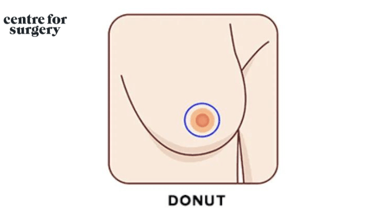 doughnut incision breast lift