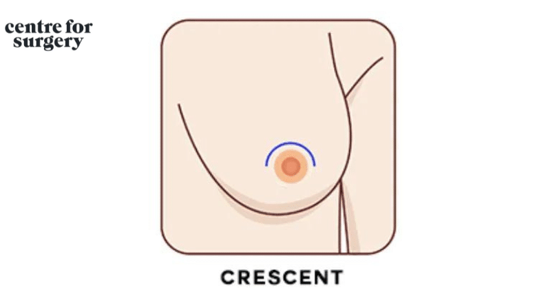 crescent incision breast lift