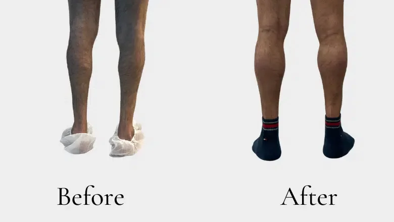 calf augmentation with implants before after