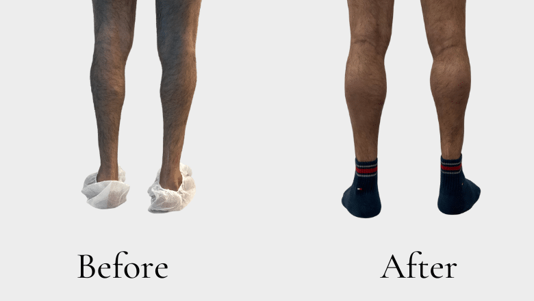 calf augmentation with implants before after