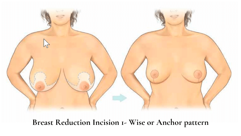 Breast Reduction Incision 1 - Wise or Anchor pattern
