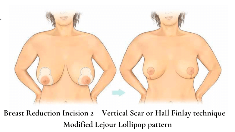 Breast Reduction Incision 2 – Vertical Scar or Hall Finlay technique – Modified Lejour Lollipop pattern