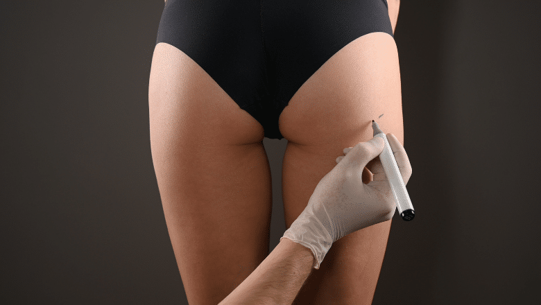 Superficial Gluteal Lipofilling London UK