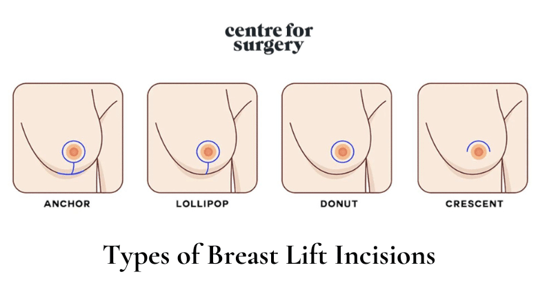 Can I Breastfeed After Different Types of Breast Surgery?