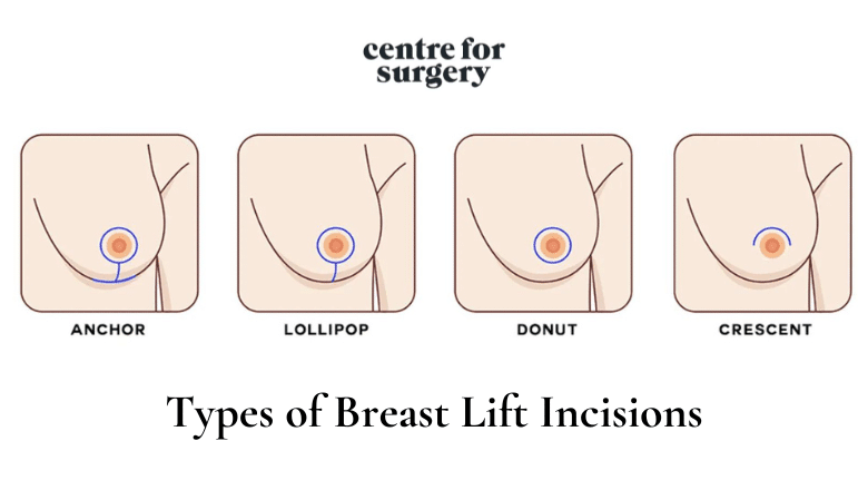 Types of Breast Lift Incisions