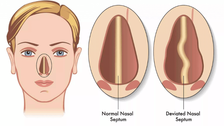 Deviated-nasal-septum.png?format=webp&nv=212368fc-2000-40d1-9026-c0f94abda644