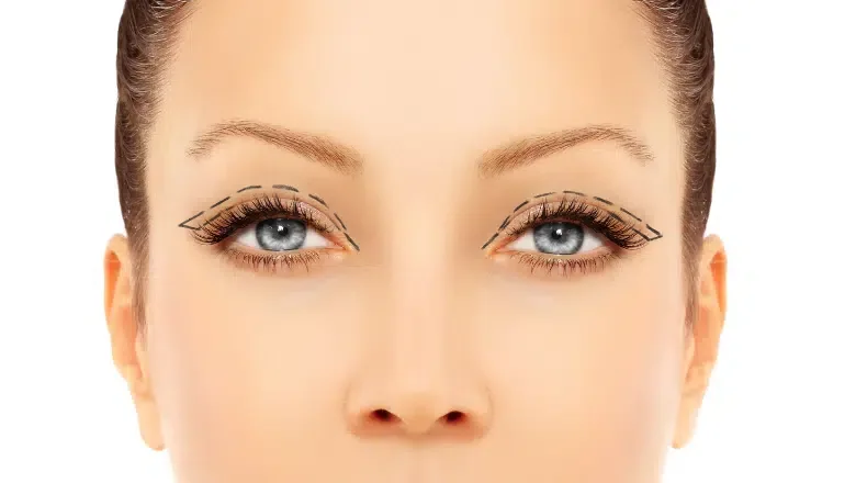 Natural Looking Blepharoplasty in London