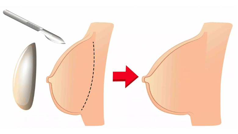 Recovery Following Breast Surgery