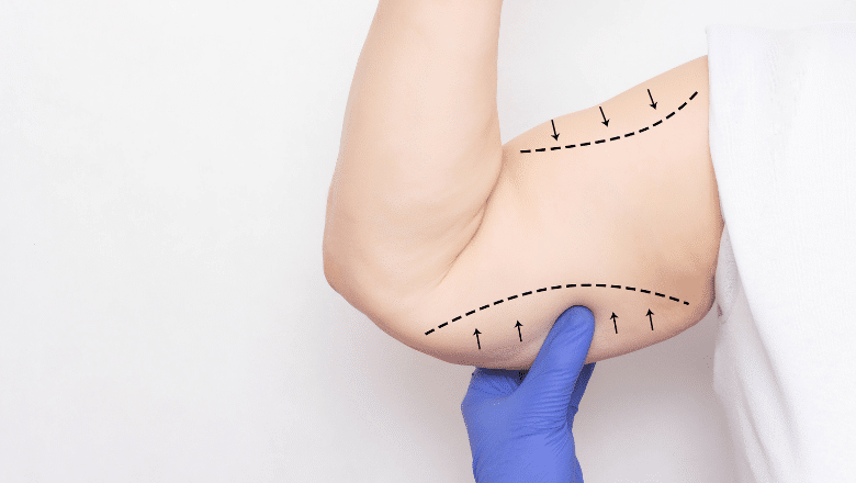 Skin Removal After Weight Loss - The Top 4 Plastic Surgery Procedures