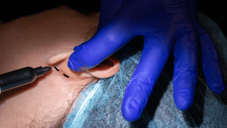 otoplasty surgery