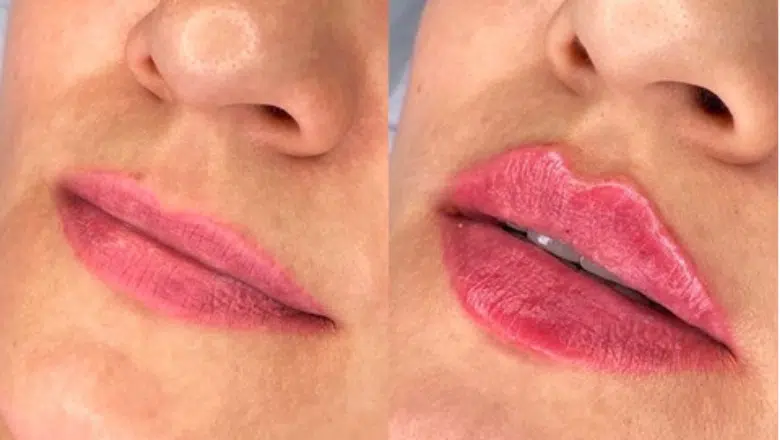 russian lip filler technique