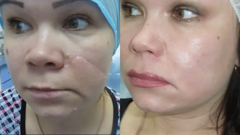 Cheek scar laser before after 8