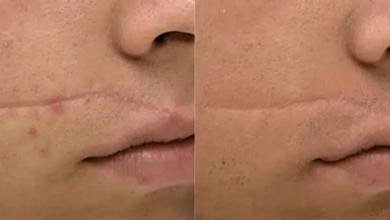 Laser-Revision-Facial-Scars-before-after-7.png.webp?format=webp&nv=212368fc-2000-40d1-9026-c0f94abda644