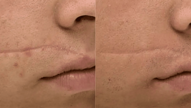 Laser Revision Facial Scars before after 7