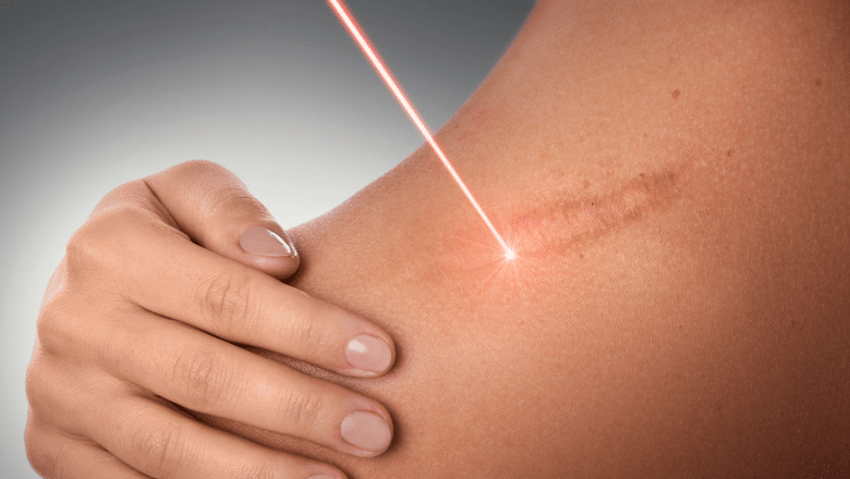 Laser Scar Removal London UK