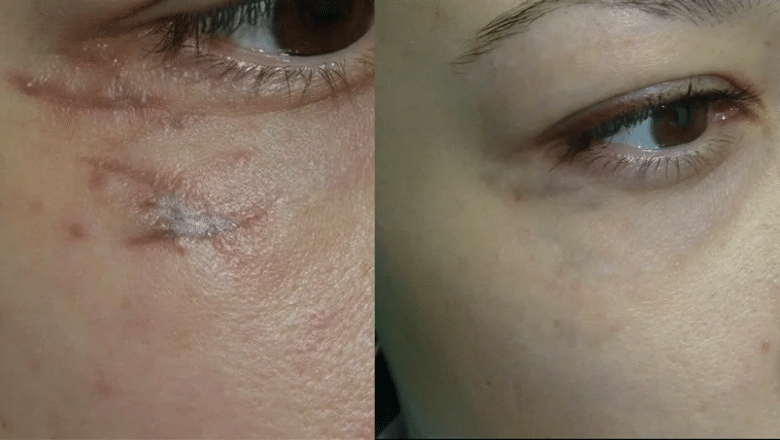 Laser Scar Removal before after 1