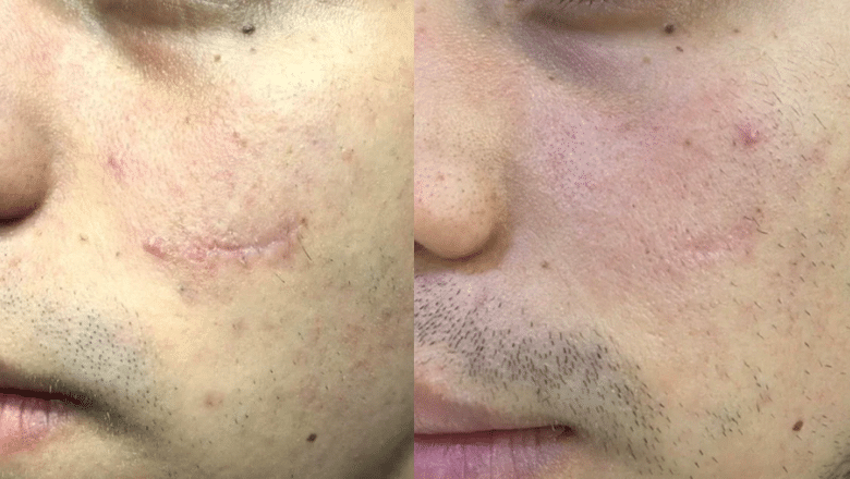 Laser Scar Removal before after 5