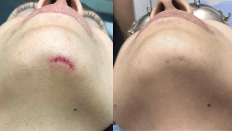 Scar Removal Laser before after 2