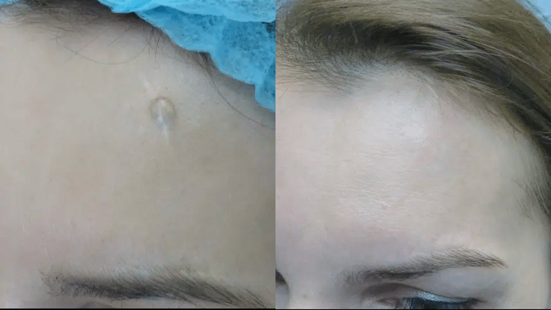 Scar Removal with Laser before after 6