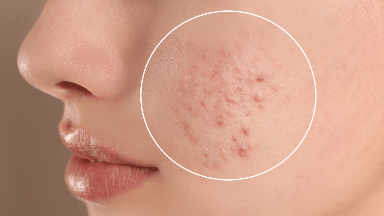 What Does Cystic Acne Look Like