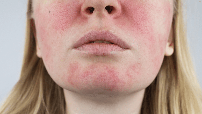 What Does Rosacea Look Like
