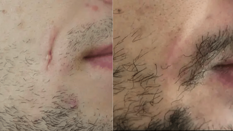 facial scar laser reduction before after 9
