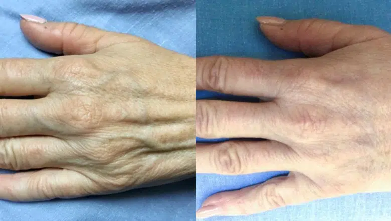 hand rejuvenation before after