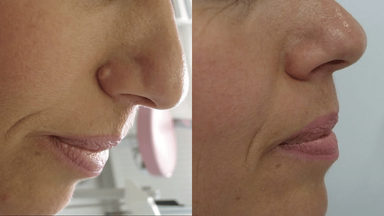 laser mole removal before after