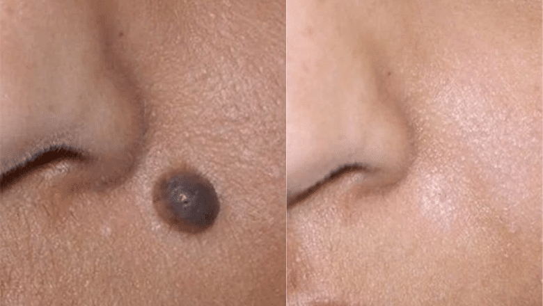 mole removal laser before after
