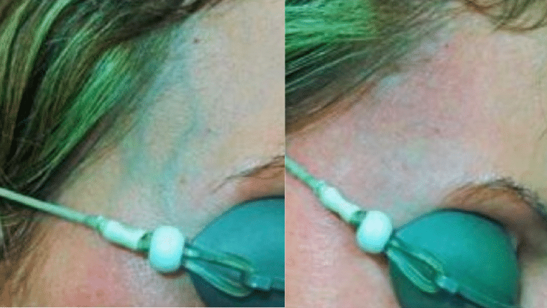 periorbital veins laser removal before after
