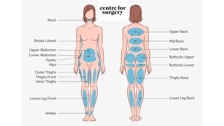 Common-Liposuction-Areas.png.webp?format=webp&nv=212368fc-2000-40d1-9026-c0f94abda644