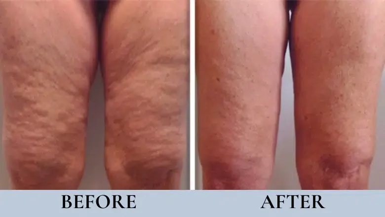 laser cellulite reduction before after