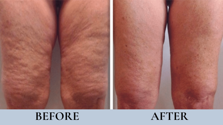 laser cellulite reduction before after