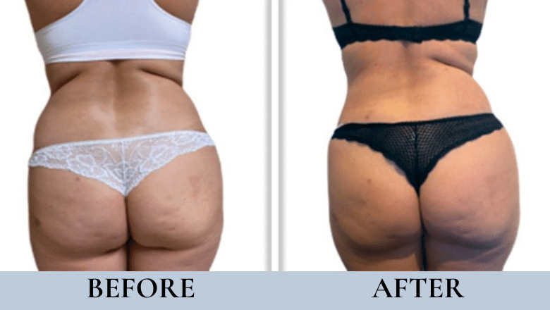 laser cellulite treatment before after
