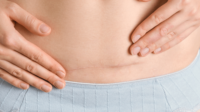 How to Prevent and Minimise C-Section Scars