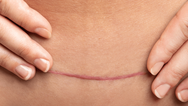 How to Reduce Scars after Body Lift Surgery