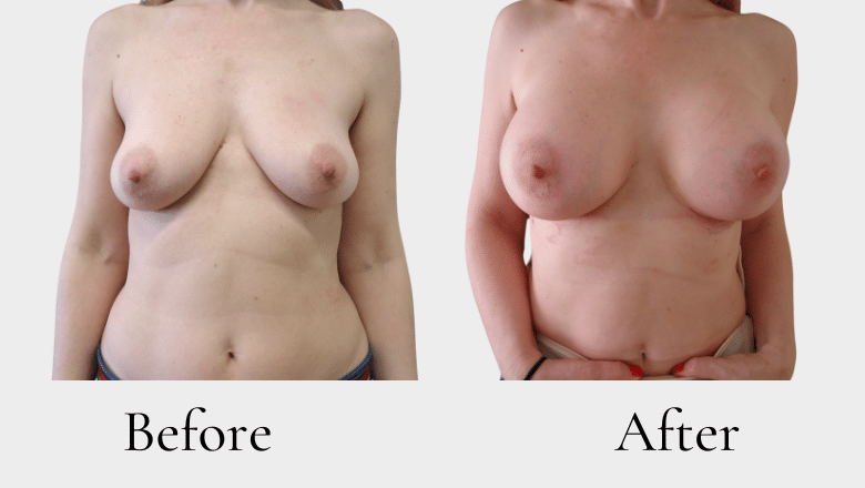 breast aug before after