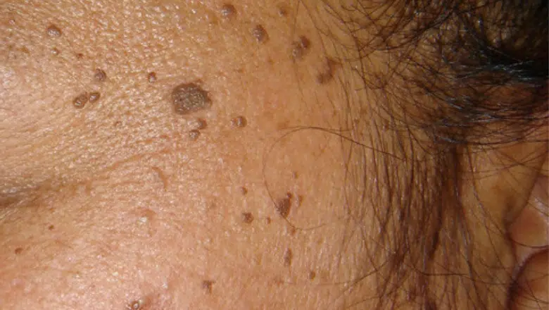 dermatosis papulosa nigra treatment