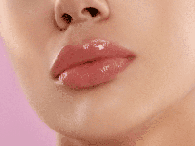 LipLase London | Lip Laser Treatment | Laser Lip Plumping UK