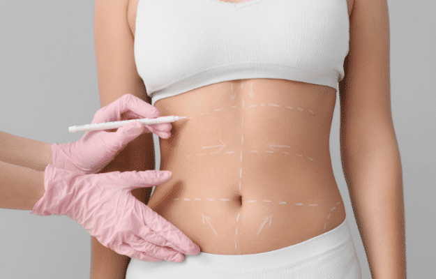 What is a Belt Lipectomy? | Centre for Surgery