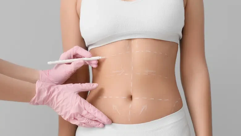 Recovery After a Fleur de Lis Tummy Tuck