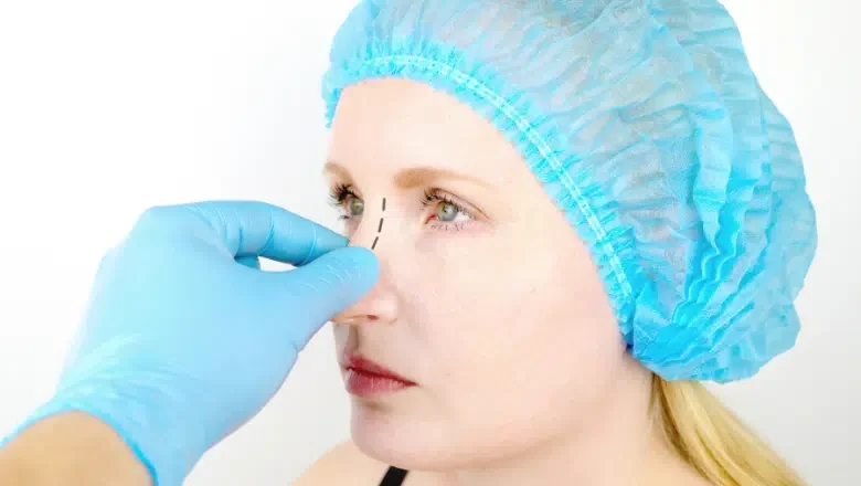 What Are Rhinoplasty Grafts and Why Are They Important