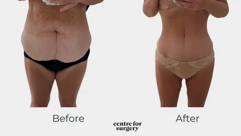 abdominoplasty and muscle repair