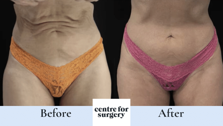 Argo plasma abdomen before after