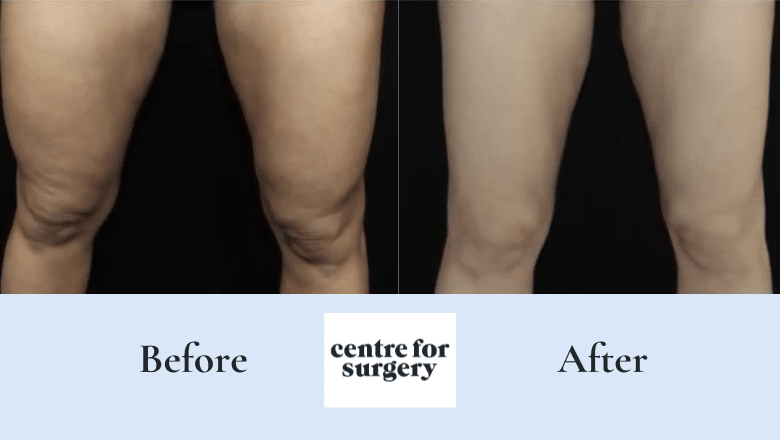 Argo plasma knees before after