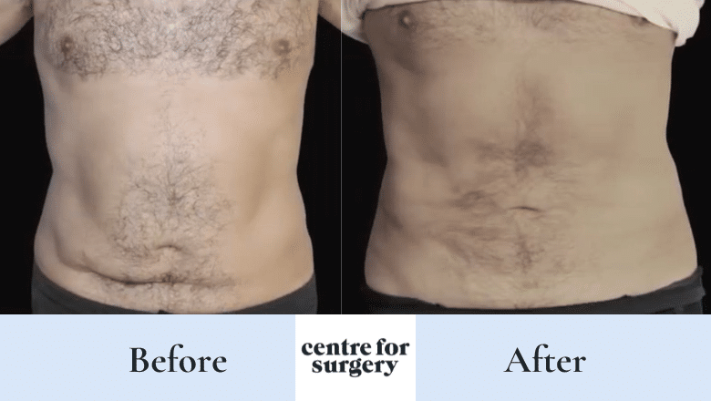 Argo plasma male abdomen before after