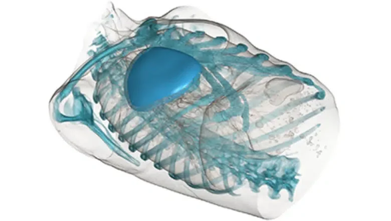 Poland Syndrome 3D custom-made implant technique