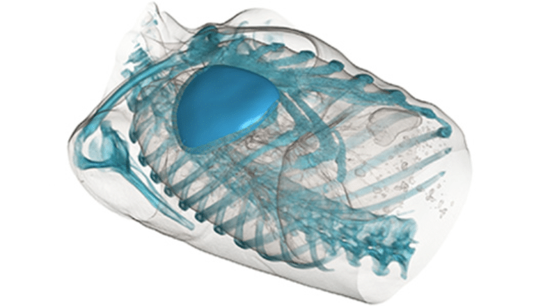 Poland Syndrome 3D custom-made implant technique